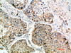 Immunohistochemical analysis of paraffin-embedded human-lung-cancer, antibody was diluted at 1:200