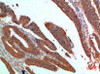 Immunohistochemical analysis of paraffin-embedded human-colon-cancer, antibody was diluted at 1:200