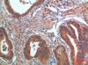 Immunohistochemical analysis of paraffin-embedded human-colon-cancer, antibody was diluted at 1:200