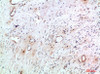 Immunohistochemical analysis of paraffin-embedded human-cervical-cancer, antibody was diluted at 1:200