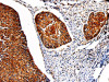 The image on the left is immunohistochemistry of paraffin-embedded Human cervical cancer tissue using CSB-PA999488 (PKM Antibody) at dilution 1/50, on the right is treated with fusion protein. (Original magnification: ×200)