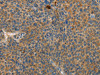 The image on the left is immunohistochemistry of paraffin-embedded Human liver cancer tissue using CSB-PA346286 (RPS27 Antibody) at dilution 1/25, on the right is treated with fusion protein. (Original magnification: ×200)