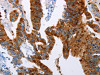 The image on the left is immunohistochemistry of paraffin-embedded Human colon cancer tissue using CSB-PA038921 (TFF3 Antibody) at dilution 1/50, on the right is treated with fusion protein. (Original magnification: ×200)