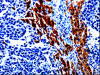 The image on the left is immunohistochemistry of paraffin-embedded Human liver cancer tissue using CSB-PA778097 (EPHX1 Antibody) at dilution 1/20, on the right is treated with fusion protein. (Original magnification: ×200)
