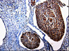 The image is immunohistochemistry of paraffin-embedded Human cervical cancer tissue using CSB-PA554992 (KLK3 Antibody) at dilution 1/25. (Original magnification: ×200)