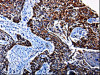 The image is immunohistochemistry of paraffin-embedded Human lung cancer tissue using CSB-PA554992 (KLK3 Antibody) at dilution 1/25. (Original magnification: ×200)