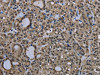 The image on the left is immunohistochemistry of paraffin-embedded Human thyroid cancer tissue using CSB-PA179850 (UBB Antibody) at dilution 1/20, on the right is treated with fusion protein. (Original magnification: ×200)