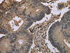 The image on the left is immunohistochemistry of paraffin-embedded Human colon cancer tissue using CSB-PA179850 (UBB Antibody) at dilution 1/20, on the right is treated with fusion protein. (Original magnification: ×200)