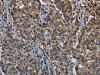 The image on the left is immunohistochemistry of paraffin-embedded Human liver cancer tissue using CSB-PA118714 (UBB Antibody) at dilution 1/20, on the right is treated with fusion protein. (Original magnification: ×200)