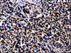 The image on the left is immunohistochemistry of paraffin-embedded Human stomach cancer tissue using CSB-PA286071 (S100A4 Antibody) at dilution 1/100, on the right is treated with fusion protein. (Original magnification: ×200)