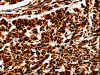 The image is immunohistochemistry of paraffin-embedded Human lung cancer tissue using CSB-PA177370 (BOLL Antibody) at dilution 1/10. (Original magnification: ×200)