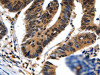 The image on the left is immunohistochemistry of paraffin-embedded Human colon cancer tissue using CSB-PA146631 (NEFL Antibody) at dilution 1/20, on the right is treated with fusion protein. (Original magnification: ×200)