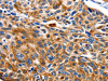 The image on the left is immunohistochemistry of paraffin-embedded Human esophagus cancer tissue using CSB-PA146631 (NEFL Antibody) at dilution 1/20, on the right is treated with fusion protein. (Original magnification: ×200)