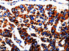 The image is immunohistochemistry of paraffin-embedded Human lung cancer tissue using CSB-PA070871 (UTS2 Antibody) at dilution 1/50. (Original magnification: ×200)