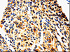 The image is immunohistochemistry of paraffin-embedded Human cervical cancer tissue using CSB-PA070871 (UTS2 Antibody) at dilution 1/50. (Original magnification: ×200)