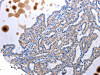 The image is immunohistochemistry of paraffin-embedded Human thyroid cancer tissue using CSB-PA779618 (UTS2 Antibody) at dilution 1/100. (Original magnification: ×200)