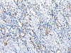 The image is immunohistochemistry of paraffin-embedded Human stomach cancer tissue using CSB-PA779618 (UTS2 Antibody) at dilution 1/100. (Original magnification: ×200)
