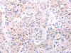 The image on the left is immunohistochemistry of paraffin-embedded Human lung cancer tissue using CSB-PA787914 (ACOT2 Antibody) at dilution 1/25, on the right is treated with fusion protein. (Original magnification: ×200)