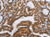 The image on the left is immunohistochemistry of paraffin-embedded Human thyroid cancer tissue using CSB-PA555438 (ACVR1B Antibody) at dilution 1/55, on the right is treated with fusion protein. (Original magnification: ×200)