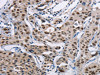 The image on the left is immunohistochemistry of paraffin-embedded Human lung cancer tissue using CSB-PA114928 (ACVR1B Antibody) at dilution 1/25, on the right is treated with fusion protein. (Original magnification: ×200)