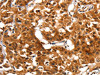 The image on the left is immunohistochemistry of paraffin-embedded Human lung cancer tissue using CSB-PA217880 (ADAP1 Antibody) at dilution 1/60, on the right is treated with fusion protein. (Original magnification: ×200)