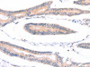 The image on the left is immunohistochemistry of paraffin-embedded Human colon cancer tissue using CSB-PA708534 (ADAP1 Antibody) at dilution 1/40, on the right is treated with fusion protein. (Original magnification: ×200)