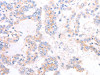 The image on the left is immunohistochemistry of paraffin-embedded Human thyroid cancer tissue using CSB-PA708534 (ADAP1 Antibody) at dilution 1/40, on the right is treated with fusion protein. (Original magnification: ×200)