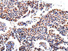 The image on the left is immunohistochemistry of paraffin-embedded Human lung cancer tissue using CSB-PA825868 (AKR1B1 Antibody) at dilution 1/40, on the right is treated with fusion protein. (Original magnification: ×200)