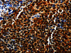 The image is immunohistochemistry of paraffin-embedded Human ovarian cancer tissue using CSB-PA098004 (AKT1 Antibody) at dilution 1/25. (Original magnification: ×200)