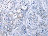 The image on the left is immunohistochemistry of paraffin-embedded Human colon cancer tissue using CSB-PA729886 (ALDH1A1/ALDH1A2/ALDH1A3 Antibody) at dilution 1/40, on the right is treated with fusion protein. (Original magnification: ×200)