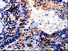 The image is immunohistochemistry of paraffin-embedded Human thyroid cancer tissue using CSB-PA043268 (ALOX5 Antibody) at dilution 1/50. (Original magnification: ×200)