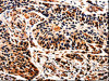 The image is immunohistochemistry of paraffin-embedded Human esophagus cancer tissue using CSB-PA787659 (ALOX5 Antibody) at dilution 1/25. (Original magnification: ×200)