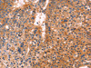 The image on the left is immunohistochemistry of paraffin-embedded Human liver cancer tissue using CSB-PA276953 (ANTXR1 Antibody) at dilution 1/25, on the right is treated with fusion protein. (Original magnification: ×200)