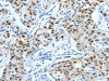 The image on the left is immunohistochemistry of paraffin-embedded Human lung cancer tissue using CSB-PA656958 (JUN Antibody) at dilution 1/30, on the right is treated with fusion protein. (Original magnification: ×200)