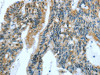 The image on the left is immunohistochemistry of paraffin-embedded Human colon cancer tissue using CSB-PA656958 (JUN Antibody) at dilution 1/30, on the right is treated with fusion protein. (Original magnification: ×200)