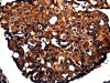 The image is immunohistochemistry of paraffin-embedded Human breast cancer tissue using CSB-PA828204 (APLP1 Antibody) at dilution 1/10. (Original magnification: ×200)