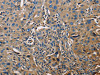 The image on the left is immunohistochemistry of paraffin-embedded Human lung cancer tissue using CSB-PA225650 (APOA1 Antibody) at dilution 1/25, on the right is treated with fusion protein. (Original magnification: ×200)