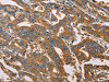 The image on the left is immunohistochemistry of paraffin-embedded Human gastric cancer tissue using CSB-PA551448 (APOA1 Antibody) at dilution 1/25, on the right is treated with fusion protein. (Original magnification: ×200)