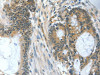 The image on the left is immunohistochemistry of paraffin-embedded Human colon cancer tissue using CSB-PA213653 (BAD Antibody) at dilution 1/60, on the right is treated with fusion protein. (Original magnification: ×200)