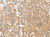 The image on the left is immunohistochemistry of paraffin-embedded Human esophagus cancer tissue using CSB-PA052042 (BAX Antibody) at dilution 1/30, on the right is treated with fusion protein. (Original magnification: ×200)