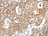 The image on the left is immunohistochemistry of paraffin-embedded Human lung cancer tissue using CSB-PA052042 (BAX Antibody) at dilution 1/30, on the right is treated with fusion protein. (Original magnification: ×200)