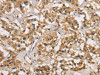 The image is immunohistochemistry of paraffin-embedded Human thyroid cancer tissue using CSB-PA984107 (CASP3 Antibody) at dilution 1/30. (Original magnification: ×200)