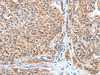 The image on the left is immunohistochemistry of paraffin-embedded Human liver cancer tissue using CSB-PA505238 (CASP7 Antibody) at dilution 1/20, on the right is treated with fusion protein. (Original magnification: ×200)