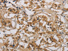 The image is immunohistochemistry of paraffin-embedded Human thyroid cancer tissue using CSB-PA785649 (CASP9 Antibody) at dilution 1/70. (Original magnification: ×200)