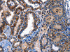 The image on the left is immunohistochemistry of paraffin-embedded Human thyroid cancer tissue using CSB-PA554957 (STAT5A Antibody) at dilution 1/25, on the right is treated with fusion protein. (Original magnification: ×200)