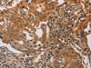 The image on the left is immunohistochemistry of paraffin-embedded Human lung cancer tissue using CSB-PA616549 (MMP1 Antibody) at dilution 1/55, on the right is treated with fusion protein. (Original magnification: ×200)