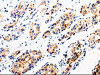 The image is immunohistochemistry of paraffin-embedded Human liver cancer tissue using CSB-PA241484 (COX16 Antibody) at dilution 1/50. (Original magnification: ×200)
