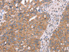 The image on the left is immunohistochemistry of paraffin-embedded Human breast cancer tissue using CSB-PA891395 (APP Antibody) at dilution 1/25, on the right is treated with fusion protein. (Original magnification: ×200)