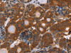 The image on the left is immunohistochemistry of paraffin-embedded Human thyroid cancer tissue using CSB-PA891395 (APP Antibody) at dilution 1/25, on the right is treated with fusion protein. (Original magnification: ×200)