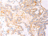 The image on the left is immunohistochemistry of paraffin-embedded Human thyroid cancer tissue using CSB-PA617153 (RELA Antibody) at dilution 1/25, on the right is treated with fusion protein. (Original magnification: ×200)
